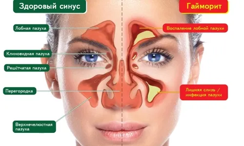хронічний гайморит класифікація