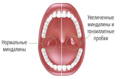 як лікувати гострий тонзиліт