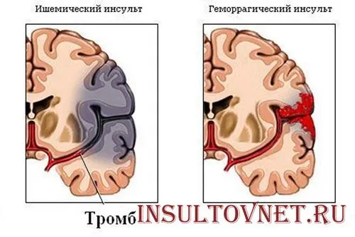 ніж лікувати інсульт головного мозку