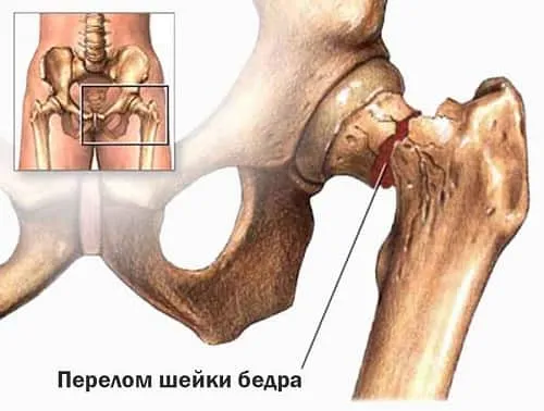 у літніх операція лікування без операції в літньому віці відновлення симптоми догляд причини скільки живуть зі зміщенням наслідки лежачий хворий що робити перша допомога прогноз ліжко травма в домашніх умовах після операції знеболити болю види як лікувати профілактика тазостегновий суглоб чобіток консервативне лікування масаж вправи реабілітація чим небезпечний чи можна сидіти харчування інвалідність гімнастика