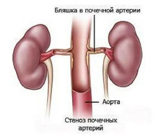 нирковий тиск