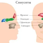 як лікувати загострення синуситу