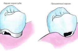 лікувати карієс домашніх умовах