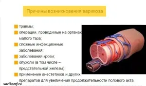 Розширення вен статевого члена: причини, лікування як вилікувати варикоз в паху