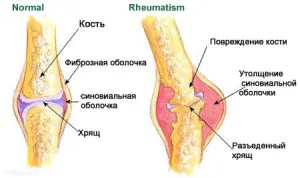 симптоми