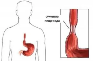 як вилікувати гастрит езофагіт
