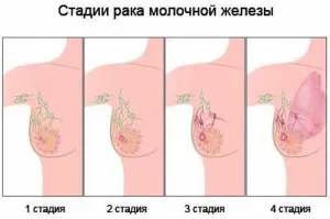 як лікувати рак молочної залози 3 стадії