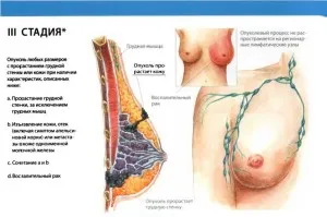 як лікувати рак молочної залози 3 стадії