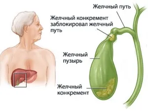 як лікувати застій жовчі в жовчному міхурі