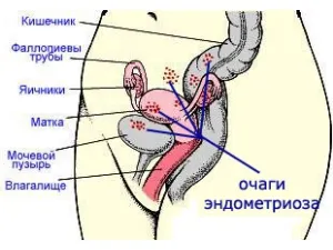 як вилікувати ендометріоз домашніми засобами