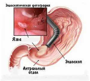 Рефлюкс гастрит лікувати рефлюкс гастрит