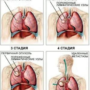 як лікувати рак легенів 3 стадія