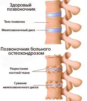 Симптоми поперекового хондроза поперековий хондроз
