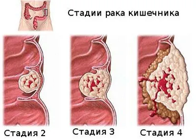 як лікувати рак дванадцятипалої кишки