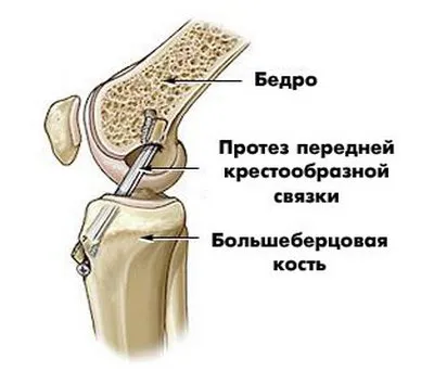 як лікувати розтягнення хрестоподібних зв'язок