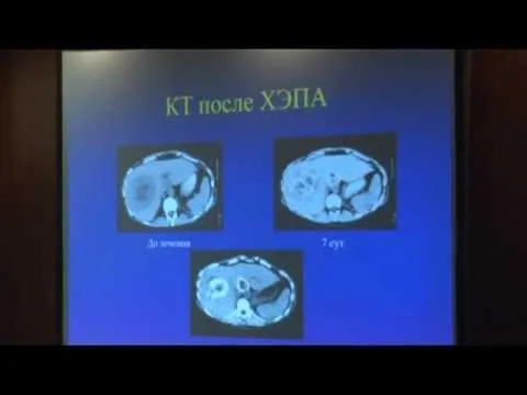 як лікувати рак кишечника 4 стадії