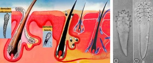 Війковий кліщ демодекс: симптоми, причини і лікування demodex на віях (відгуки) як лікувати очної демодекс