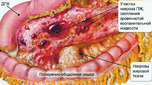 Рак підшлункової залози рак підшлункової
