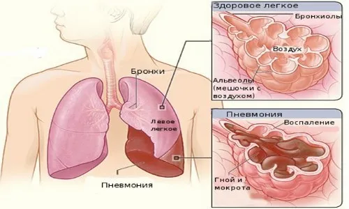 скільки лікувати пневмонію