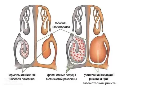 хронічний нежить психологічні причини