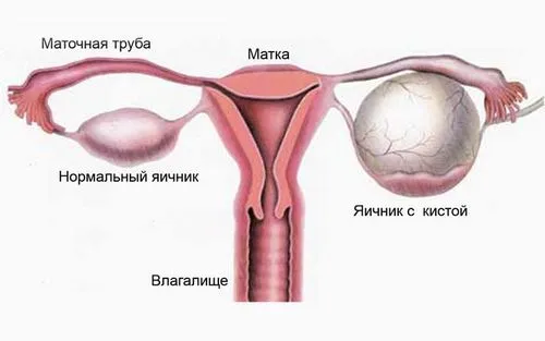 як лікувати кісту у жінок