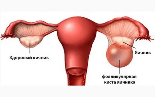 як лікувати кісту у жінок