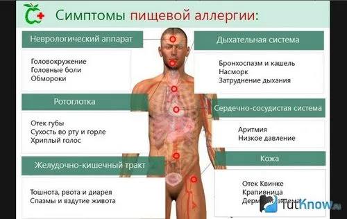 харчова алергія