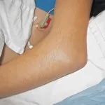 як лікувати розтягнення передпліччя