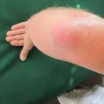 як лікувати забій ліктьового суглоба