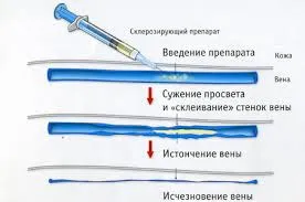 варикоз на руках