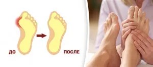 як лікувати суглоб великого пальця ноги