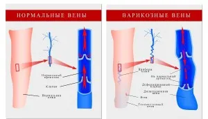 як лікувати варикоз на початковій стадії