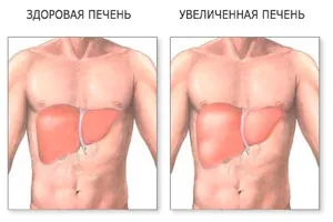 Збільшена печінка - народне лікування збільшена печінка