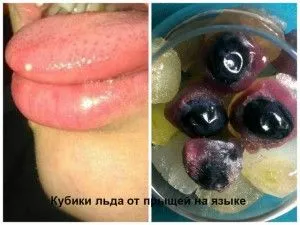 як лікувати типун мовою