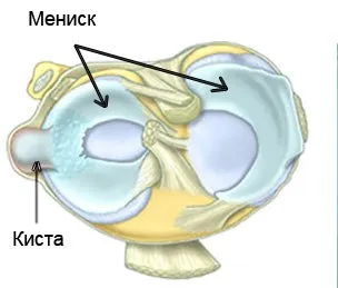 як лікувати медіальний меніск