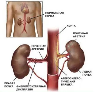 як лікувати стеноз ниркової артерії