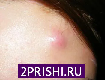 як лікувати прищі шишки