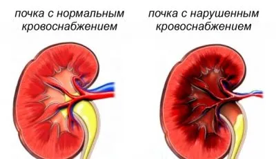 як лікувати стеноз ниркової артерії