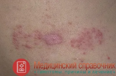 як лікувати стрептодермії у дорослих в домашніх умовах