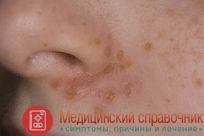 як лікувати стрептодермії у дорослих в домашніх умовах