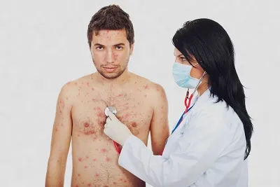лікувати вітрянку дорослому