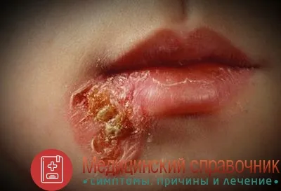 стрептодермія діти фото лікування симптоми домашні умови дорослі суха передається причини особа