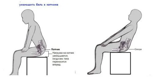 як лікувати застарілий забій куприка