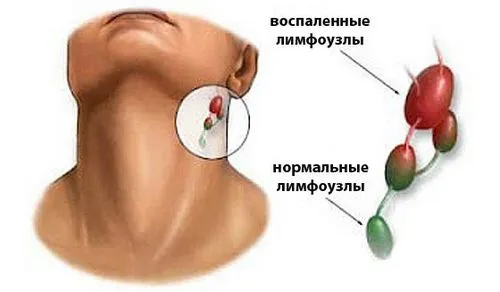 як лікувати запалені лімфовузли у вагітних