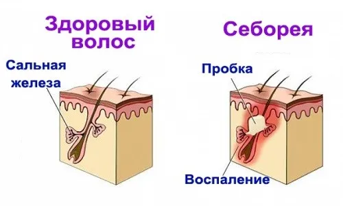 Змішана себорея як лікувати змішану себорею