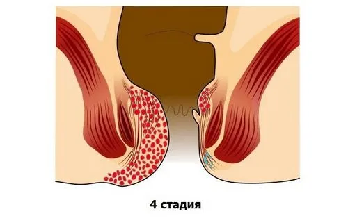 геморой хронічний