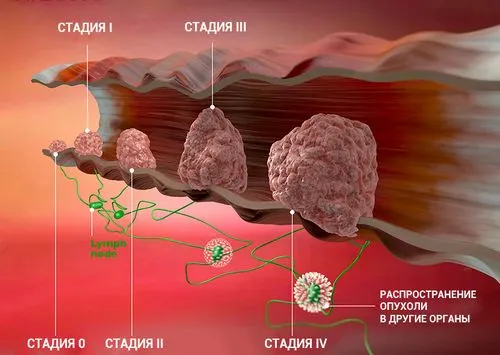 tnm класифікація раку