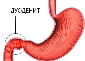 Durerea deasupra buricului - o trecere în revistă a motivelor (pierdere în greutate) Durerea deasupra buricului - o trecere în revistă a motivelor