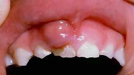 Clåtirea gura cu inflamarea gingiilor si sangerarea gingiilor (gumă de mestecat) Clåtirea gura cu inflamarea gingiilor si sangerarea gingiilor