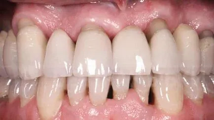 Clåtirea gura cu inflamarea gingiilor si sangerarea gingiilor (sângerare) Clåtirea gura cu inflamarea gingiilor si sangerarea gingiilor